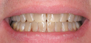 photo of discolored teeth before deep bleaching