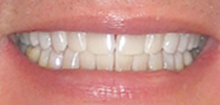 photo of white teeth after deep bleaching