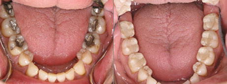 photo of teeth with inlays and onlays